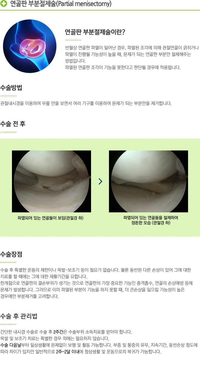 연골판 부분절제술